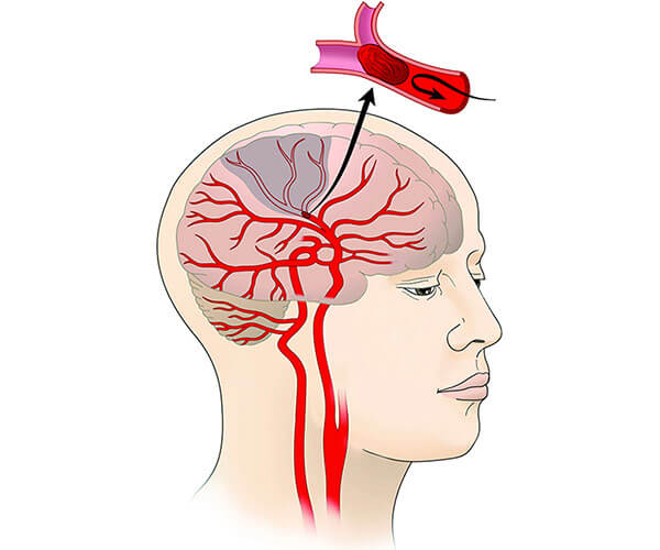 Нос и головной мозг. Ишемия ишемический инсульт мозга. Ишемия и инсульт мозга.